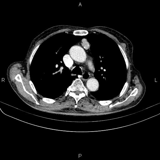 Ampullary adenocarcinoma (Radiopaedia 86093-102033 B 27).jpg