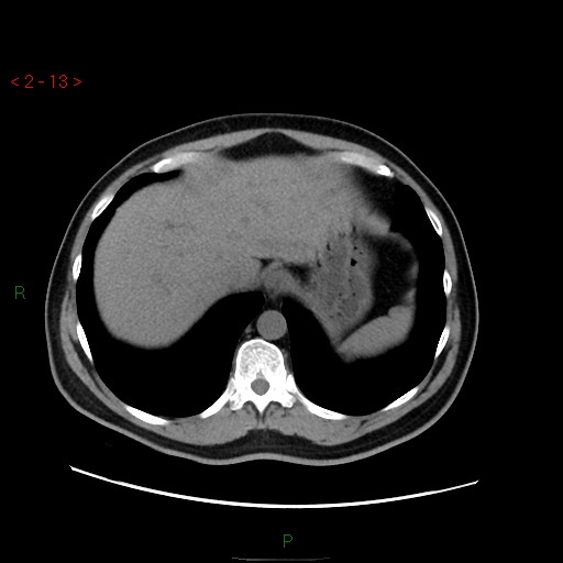 File:Ampullary carcinoma (Radiopaedia 56396-63056 Axial non-contrast 9).jpg