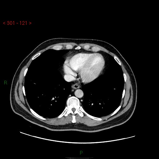 Ampullary carcinoma (Radiopaedia 56396-63056 C 8).jpg