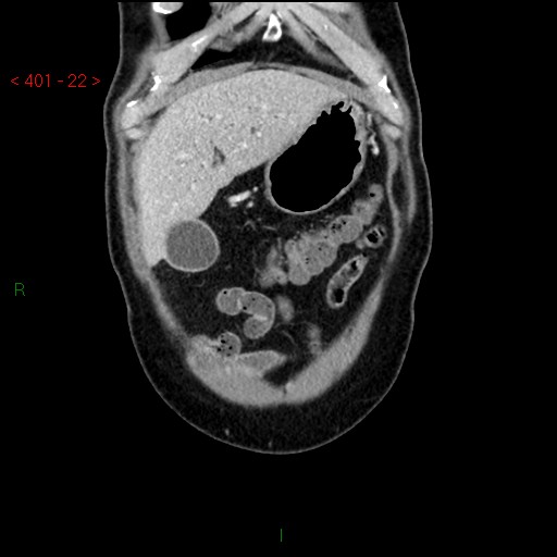 Ampullary carcinoma (Radiopaedia 56396-63056 E 21).jpg