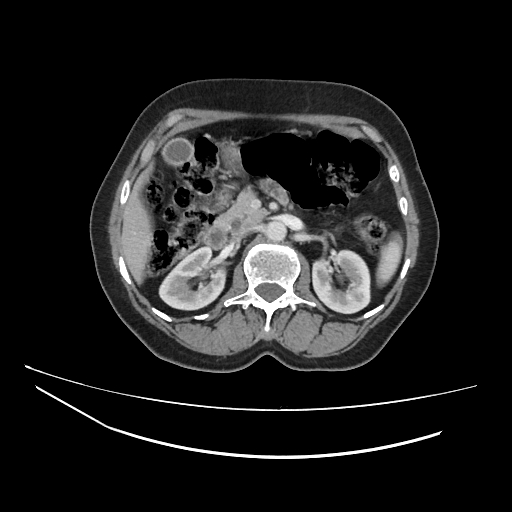 Ampullary tumor (Radiopaedia 60333-67998 A 29).jpg