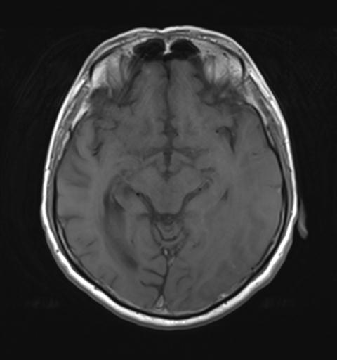 File:Amyloid angiopathy with inflammation (Radiopaedia 30360-31002 Axial T1 14).jpg