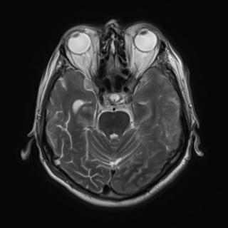 File:Amyloid angiopathy with inflammation (Radiopaedia 30360-31002 Axial T2 11).jpg