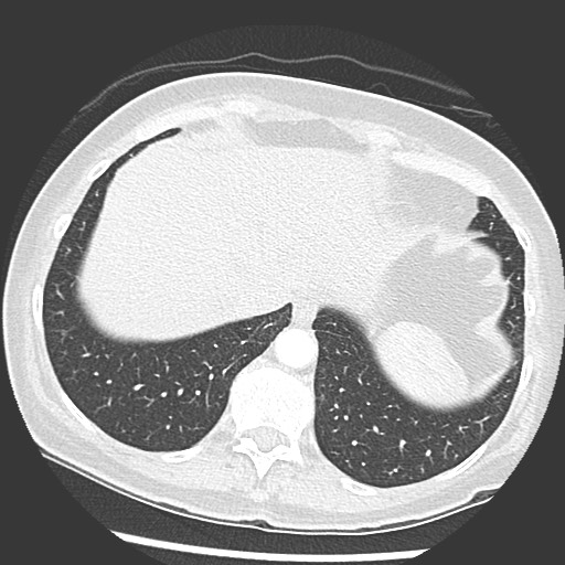 Amyloidosis - bronchial and diffuse nodular pulmonary involvement (Radiopaedia 60156-67745 Axial lung window 71).jpg