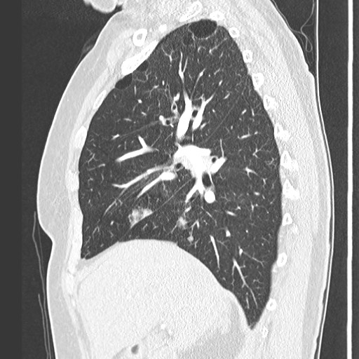 Amyloidosis - bronchial and diffuse nodular pulmonary involvement (Radiopaedia 60156-67745 Sagittal lung window 32).jpg