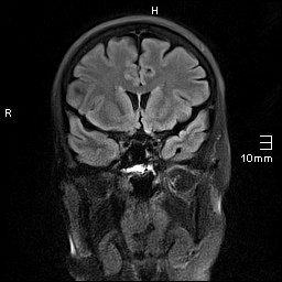 File:Amyotrophic lateral sclerosis (Radiopaedia 70821-81017 Coronal FLAIR 11).jpg