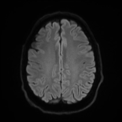 File:Amyotrophic lateral sclerosis (Radiopaedia 87352-103658 Axial DWI 48).jpg