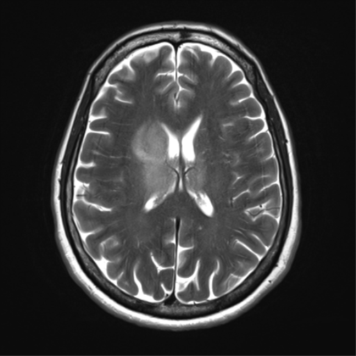 File:Anaplastic astrocytoma - thalamic glioma (Radiopaedia 59709-67115 Axial T2 23).png