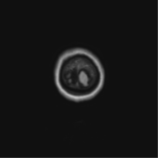 File:Anaplastic astrocytoma IDH mutant (Radiopaedia 50046-55341 Coronal FLAIR 3).png