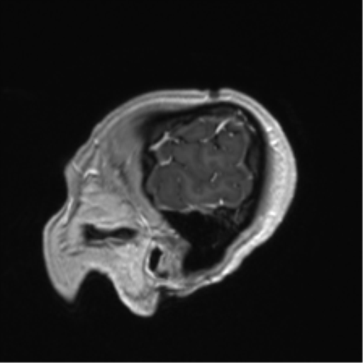 Anaplastic astrocytoma IDH mutant (Radiopaedia 50046-55341 Sagittal T1 C+ 54).png