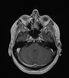 Anaplastic astrocytoma IDH wild-type (Radiopaedia 49984-55273 Axial T1 C+ 16).png