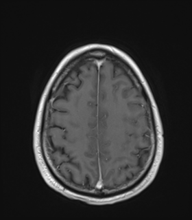 Anaplastic astrocytoma IDH wild-type (Radiopaedia 49984-55273 Axial T1 C+ 45).png