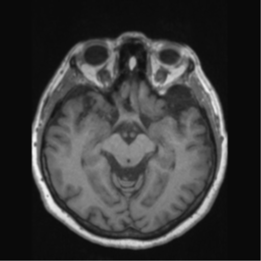 Anaplastic astrocytoma IDH wild-type (pseudoprogression) (Radiopaedia 42209-45276 Axial T1 67).png