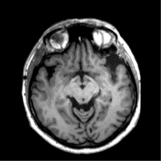 Anaplastic astrocytoma IDH wild-type (pseudoprogression) (Radiopaedia 42209-45277 Axial T1 56).png