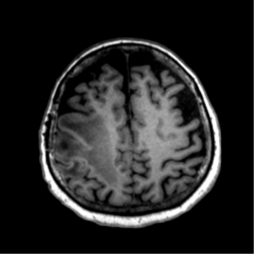 Anaplastic astrocytoma IDH wild-type (pseudoprogression) (Radiopaedia 42209-45277 Axial T1 98).png