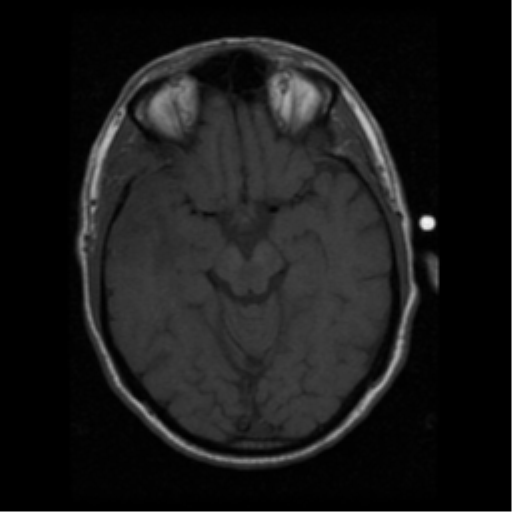File:Anaplastic meningioma with recurrence (Radiopaedia 34452-35783 Axial T1 8).png