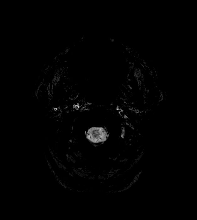 Anaplastic oligodendroglioma (Radiopaedia 79571-92754 F 3).jpg