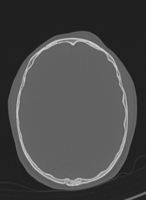 Anaplastic oligodendroglioma with skull fracture (Radiopaedia 74831-85846 Axial bone window 22).png