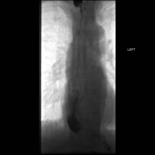 File:Anastomotic stricture post Ivor Lewis esophagectomy (Radiopaedia 47937-52715 B 47).png