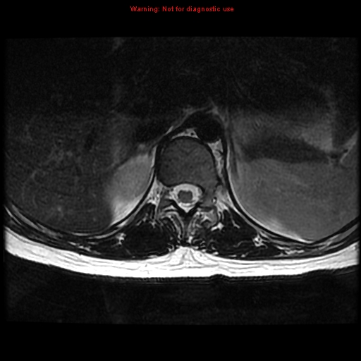 File:Aneurysmal bone cyst (Radiopaedia 9419-10103 Axial T2 18).jpg
