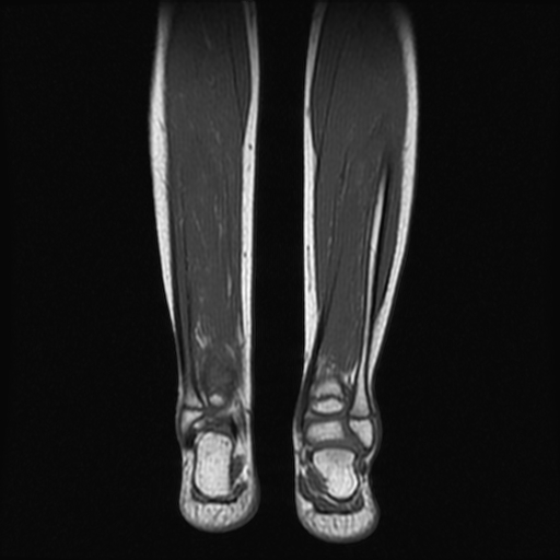 File:Aneurysmal bone cyst - tibia (Radiopaedia 22343-22367 Coronal T1 13).jpg