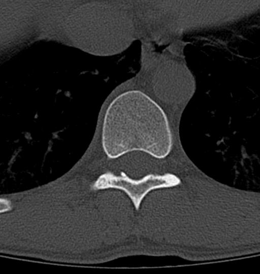 File:Aneurysmal bone cyst T11 (Radiopaedia 29294-29721 Axial bone window 34).jpg