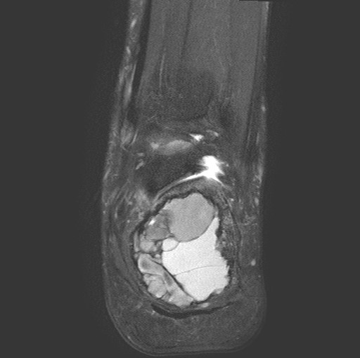 File:Aneurysmal bone cyst of the calcaneus (Radiopaedia 60669-68420 Coronal T2 fat sat 16).jpg