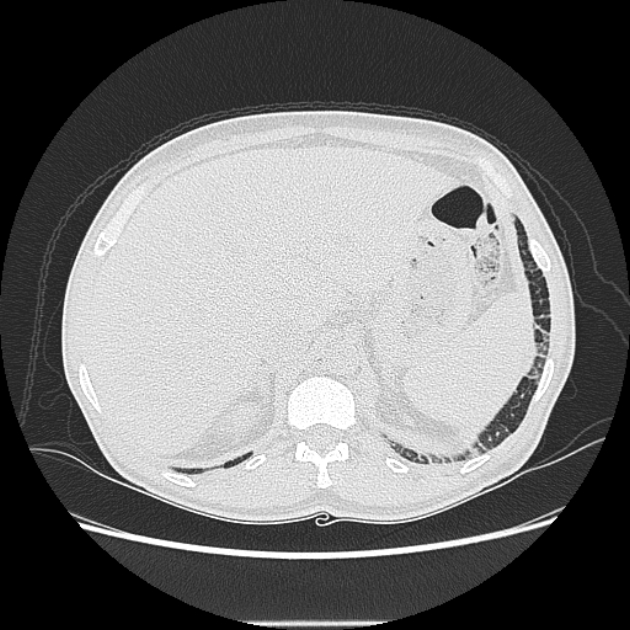 Angioinvasive aspergellosis (Radiopaedia 66995-76315 Axial lung window 50).jpg