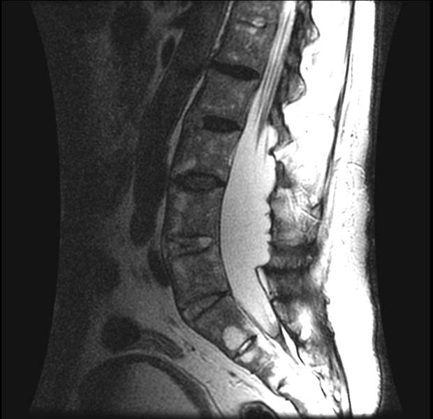 File:Ankylosing spondylitis (Radiopaedia 11188-11553 Sagittal 2).jpg