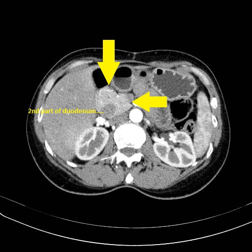 File:Annular pancreas (Radiopaedia 28905-29222 Axial arterial phase 1).jpg