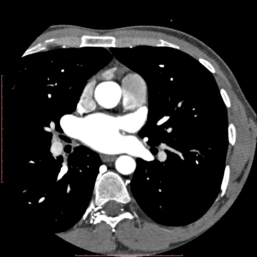 Anomalous left coronary artery from the pulmonary artery (ALCAPA) (Radiopaedia 70148-80181 A 64).jpg