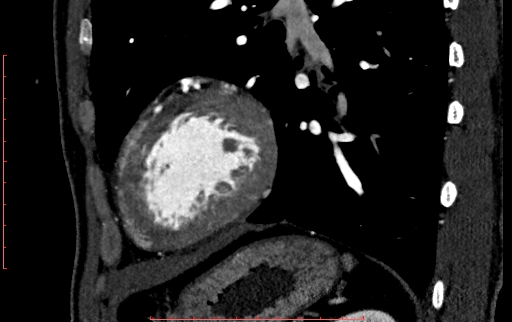 Anomalous left coronary artery from the pulmonary artery (ALCAPA) (Radiopaedia 70148-80181 C 203).jpg