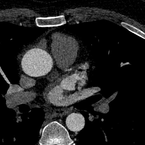 File:Anomalous origin of the left coronary artery with malignant course (Radiopaedia 77842-90126 C 8).jpeg