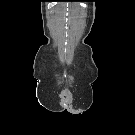 Anorectal carcinoma (Radiopaedia 44413-48064 B 88).jpg