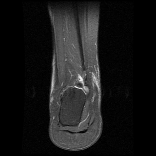 File:Anterior calcaneal process fracture (Radiopaedia 71377-81705 Coronal PD fat sat 13).jpg