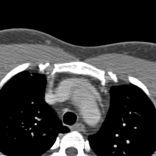 File:Anterior cerebral artery territory infarct (Radiopaedia 39327-41581 B 111).png