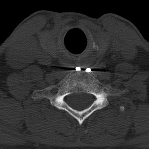 Anterior cervical postdiscectomy arthrodesis (Radiopaedia 32678-33646 Axial bone window 58).jpg