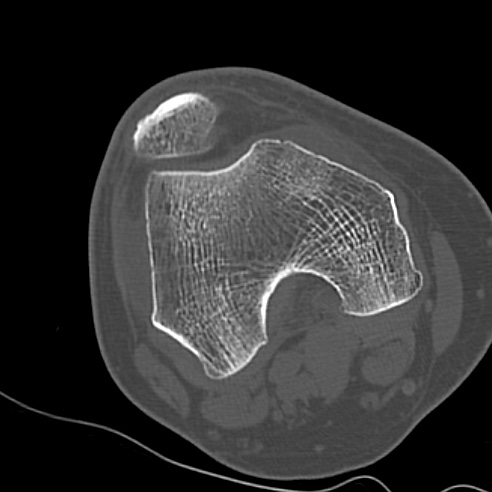 File:Anterior cruciate ligament avulsion fracture (Radiopaedia 58939-66194 Axial bone window 3).jpg