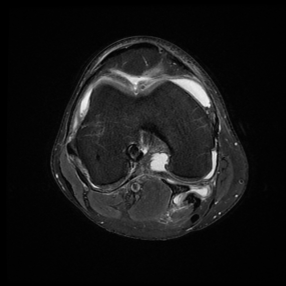 File:Anterior cruciate ligament graft tear and bucket-handle tear of medial meniscus (Radiopaedia 75867-87255 Axial PD fat sat 12).jpg