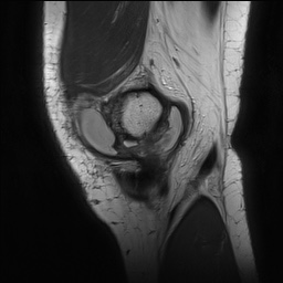 Anterior cruciate ligament rupture with Segond fracture (Radiopaedia 69043-78806 Sagittal PD 33).jpg