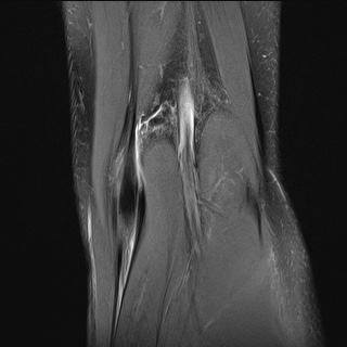 File:Anterior cruciate ligament tear - pediatric (Radiopaedia 62152-70260 Coronal PD fat sat 2).jpg