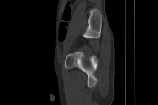 Anterior inferior iliac spine avulsion injury (Radiopaedia 88666-105376 Sagittal bone window 67).jpg