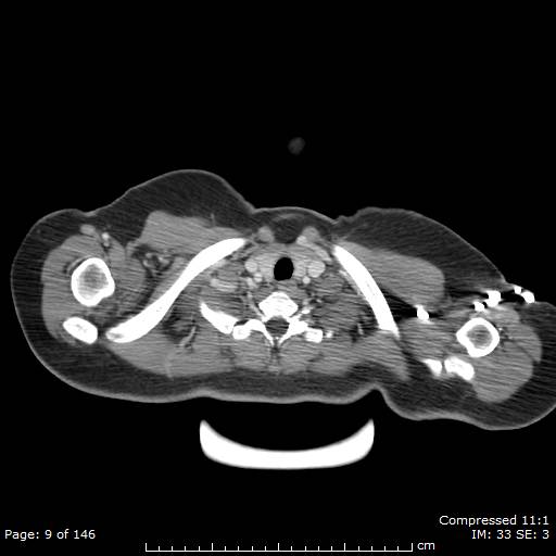 File:Anterior mediastinal B cell Lymphoma (Radiopaedia 50677-56114 A 5).jpg
