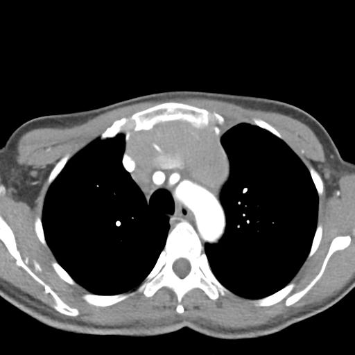 Anterior mediastinal lymphoma (Radiopaedia 29556-30061 C 15).jpg