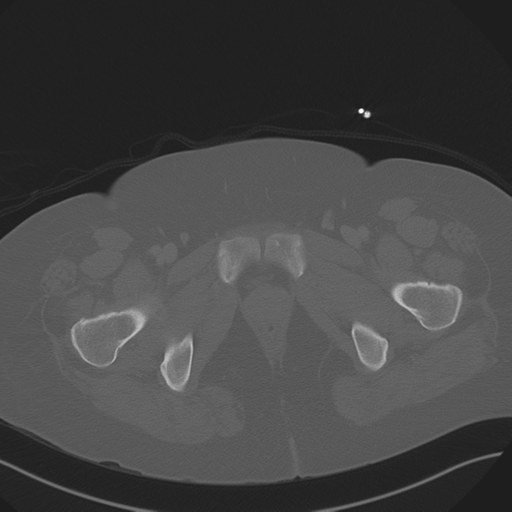 Anterior superior iliac spine avulsion fracture (Radiopaedia 44541-48244 Axial bone window 101).png