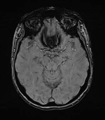 Anterior temporal lobe perivascular space (Radiopaedia 40946-43650 Axial SWI 34).png