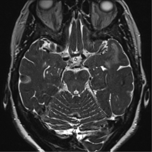 Anterior temporal pole cysts (Radiopaedia 46629-51102 Axial 42).png