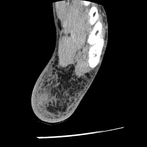 Anterior tibial artery false aneurysm (Radiopaedia 88984-105809 A 235).jpg