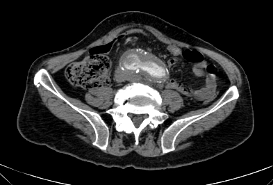 Anterior vertebral scalloping (abdominal aortic aneurysm) (Radiopaedia 66744-76067 F 64).jpg