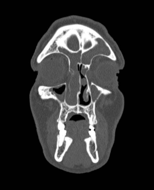 Antrochoanal polyp (Radiopaedia 79011-92169 Coronal bone window 69).jpg